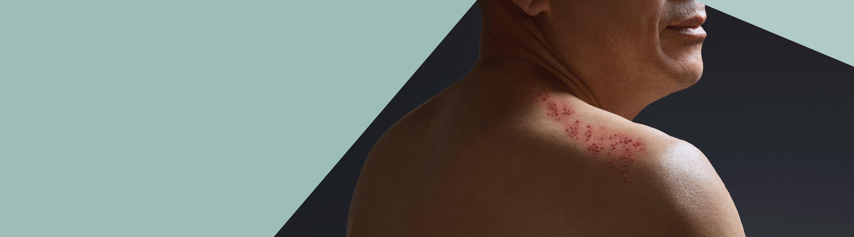 man with shingles rash on shoulder