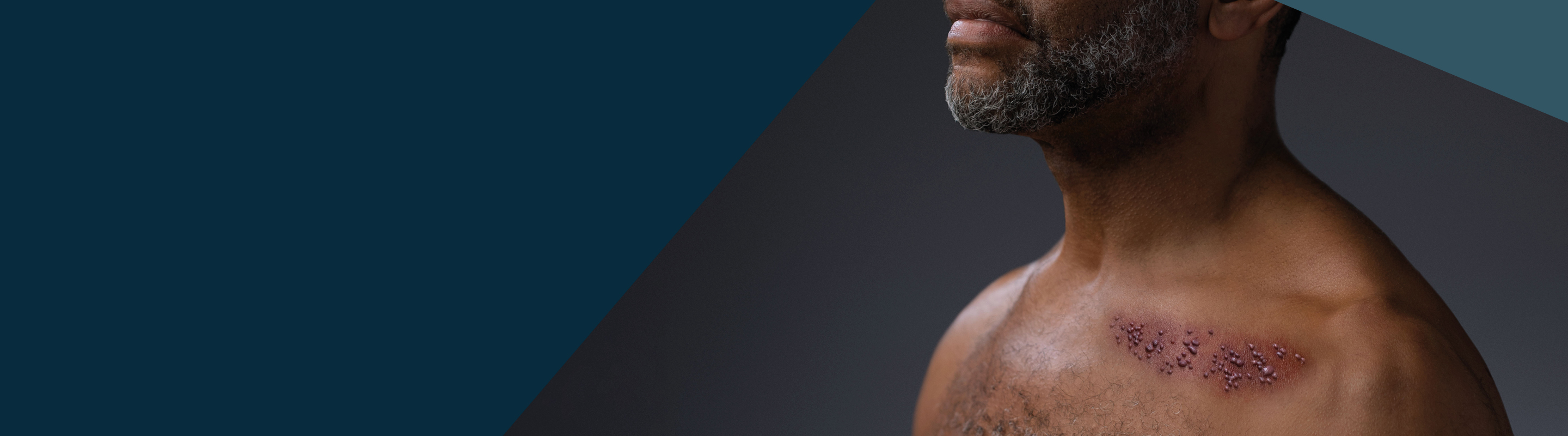 man with shingles rash on chest